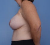 Patient 302 - 3D Tattoo Photo 1 - Breast Augmentation DIEP Flap Surgery - Breast Cancer Texas