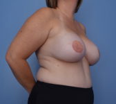 Patient 302 - 3D Tattoo Photo 4 - Breast Augmentation DIEP Flap Surgery - Breast Cancer Texas