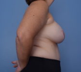Patient 302 - 3D Tattoo Photo 5 - Breast Augmentation DIEP Flap Surgery - Breast Cancer Texas