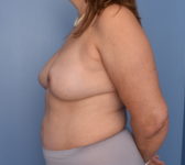 Patient 560 - 1 year out after completion of reconstruction Photo 1 - DIEP Flap Surgery - Breast Cancer Texas