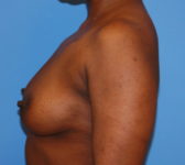 Patient 669 Before Surgey Photo 1 - Tissue Expander Implant - Breast Cancer Texas