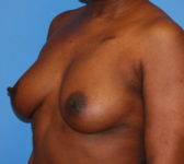 Patient 669 Before Surgey Photo 2 - Tissue Expander Implant - Breast Cancer Texas