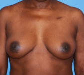 Patient 669 Before Surgey Photo 3 - Tissue Expander Implant - Breast Cancer Texas