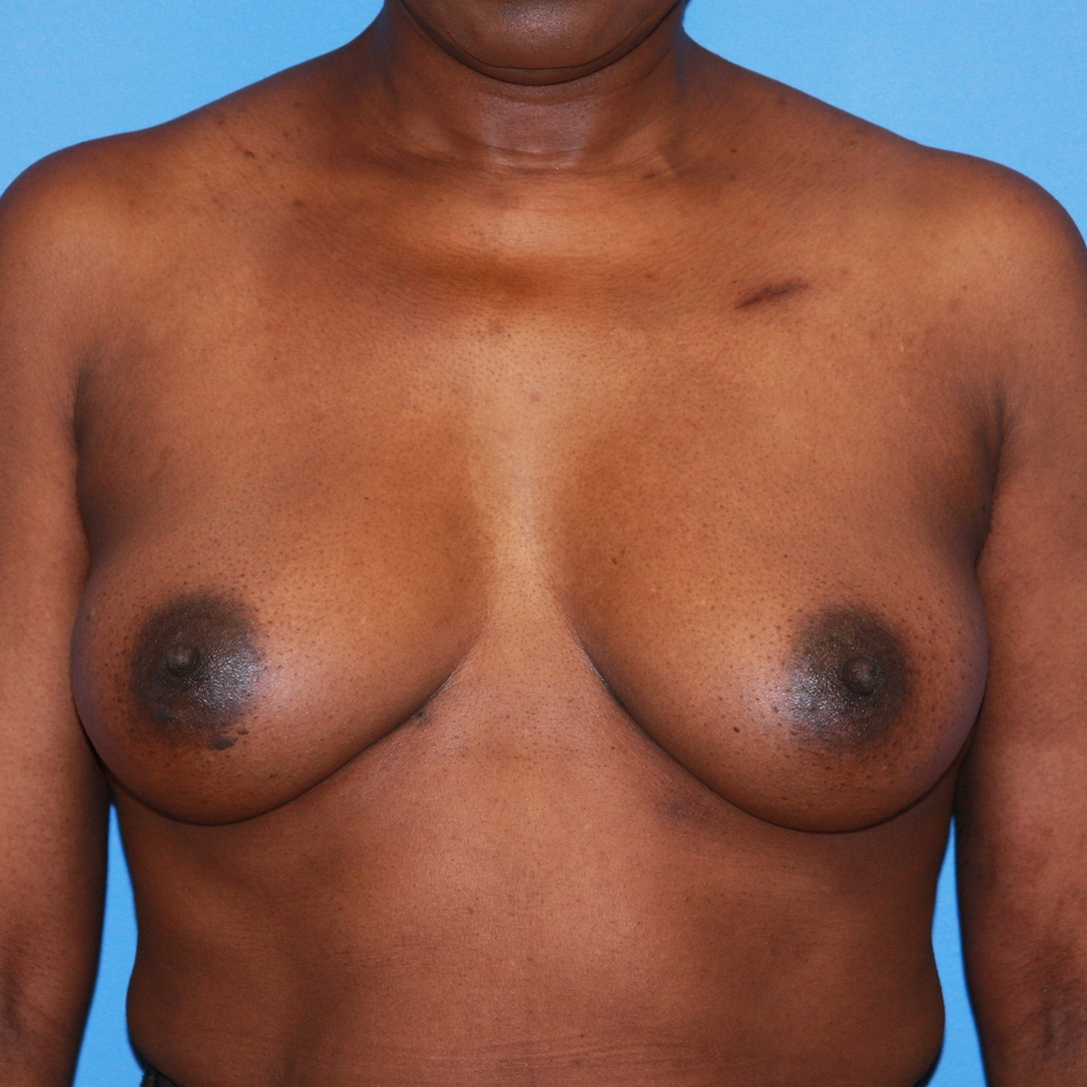Patient 669 Before Overview - Sidebar - Tissue Expander Implant - Breast Cancer Texas