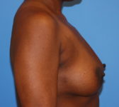 Patient 669 Before Surgey Photo 5 - Tissue Expander Implant - Breast Cancer Texas