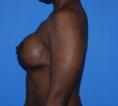 Patient 669 - Surgery 1 Photo 1 - Tissue Expander Implant - Breast Cancer Texas
