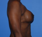 Patient 669 - Surgery 1 Photo 5 - Tissue Expander Implant - Breast Cancer Texas