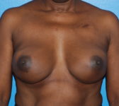Patient 669 - Surgery 2 Photo 3 - Tissue Expander Implant - Breast Cancer Texas