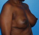 Patient 669 - Surgery 2 Photo 4 - Tissue Expander Implant - Breast Cancer Texas