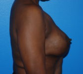 Patient 669 - Surgery 2 Photo 5 - Tissue Expander Implant - Breast Cancer Texas