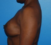 Patient 669 - Surgery 3 Photo 1 - Tissue Expander Implant - Breast Cancer Texas