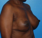 Patient 669 - Surgery 3 Photo 4 - Tissue Expander Implant - Breast Cancer Texas