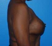 Patient 669 - Surgery 3 Photo 5 - Tissue Expander Implant - Breast Cancer Texas