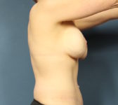 Patient 86 - 2 years out from tattoo Photo 5 - DIEP Flap Surgery - Breast Cancer Texas