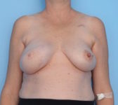 Patient 421 After Overview - Latissimus Muscle - Breast Cancer Texas