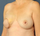 Patient 421 - Surgery 1 Photo 2 - Latissimus Muscle - Breast Cancer Texas