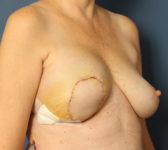 Patient 421 - Surgery 1 Photo 4 - Latissimus Muscle - Breast Cancer Texas