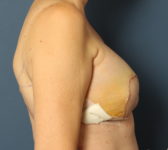 Patient 421 - Surgery 1 Photo 5 - Latissimus Muscle - Breast Cancer Texas
