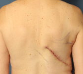 Patient 421 - Latissimus Donor Site Photo 1 - Latissimus Muscle - Breast Cancer Texas