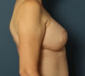 Patient 421 - Surgery 2 Photo 5 - Latissimus Muscle - Breast Cancer Texas