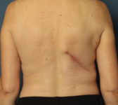 Patient 421 - Latissimus Donor Site Photo 2 - Latissimus Muscle - Breast Cancer Texas