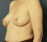 Patient 421 - Surgery 3 Photo 2 - Latissimus Muscle - Breast Cancer Texas