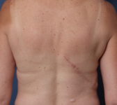 Patient 421 - Latissimus Donor Site Photo 3 - Latissimus Muscle - Breast Cancer Texas