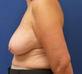 Patient 589 Before Surgey Photo 1 - Mastopexy Breast Reduction Lumpectomy Breast Reduction-Lift - Breast Cancer Texas