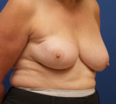 Patient 589 Before Surgey Photo 4 - Mastopexy Breast Reduction Lumpectomy Breast Reduction-Lift - Breast Cancer Texas