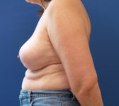Patient 589 - Surgery 1 Photo 1 - Mastopexy Breast Reduction Lumpectomy Breast Reduction-Lift - Breast Cancer Texas