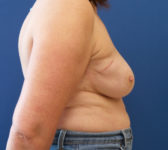 Patient 589 - Surgery 1 Photo 5 - Mastopexy Breast Reduction Lumpectomy Breast Reduction-Lift - Breast Cancer Texas