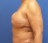 Patient 67 - Surgery 1 Photo 1 - DIEP Flap Surgery - Breast Cancer Texas