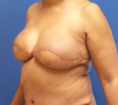 Patient 67 - Surgery 1 Photo 2 - DIEP Flap Surgery - Breast Cancer Texas