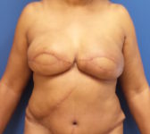 Patient 67 - Surgery 1 Photo 3 - DIEP Flap Surgery - Breast Cancer Texas