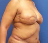 Patient 67 - Surgery 1 Photo 4 - DIEP Flap Surgery - Breast Cancer Texas