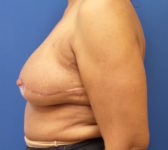 Patient 67 - Surgery 2/3 Photo 1 - DIEP Flap Surgery - Breast Cancer Texas
