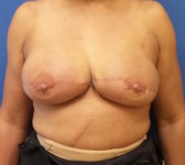 Patient 67 - Surgery 2/3 Photo 2 - DIEP Flap Surgery - Breast Cancer Texas