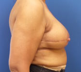 Patient 67 - Surgery 2/3 Photo 3 - DIEP Flap Surgery - Breast Cancer Texas