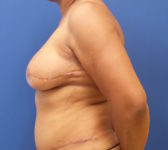 Patient 67 - Surgery 4 Photo 1 - DIEP Flap Surgery - Breast Cancer Texas