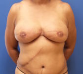 Patient 67 After Overview - DIEP Flap Surgery - Breast Cancer Texas