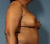 Patient 33 - 3D Tattoo Photo 5 - DIEP Flap Surgery - Breast Cancer Texas