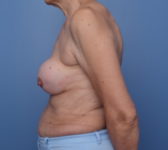 Patient 740 Before Surgey Photo 1 - Nipple Sparing Mastectomy Tissue Expander Implant - Breast Cancer Texas