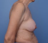 Patient 740 Before Surgey Photo 5 - Nipple Sparing Mastectomy Tissue Expander Implant - Breast Cancer Texas