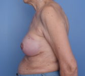 Patient 740 - Surgery 1 Photo 1 - Nipple Sparing Mastectomy Tissue Expander Implant - Breast Cancer Texas