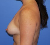 Patient 79 Before Surgey Photo 1 - Tissue Expander Implant - Breast Cancer Texas