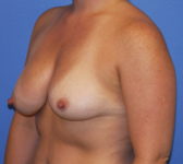 Patient 79 Before Surgey Photo 2 - Tissue Expander Implant - Breast Cancer Texas