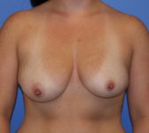 Patient 79 Before Surgey Photo 3 - Tissue Expander Implant - Breast Cancer Texas