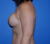 Patient 79 - Surgery 1 Photo 1 - Tissue Expander Implant - Breast Cancer Texas