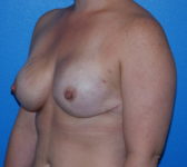 Patient 79 - Surgery 2 Photo 2 - Tissue Expander Implant - Breast Cancer Texas