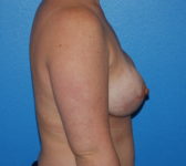 Patient 79 - Surgery 2 Photo 5 - Tissue Expander Implant - Breast Cancer Texas